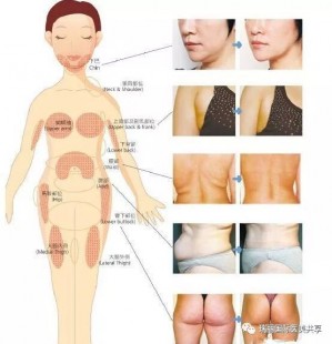 溶脂针效果,溶脂针的作用与功效
