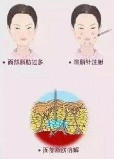 溶脂针效果,溶脂针的作用与功效