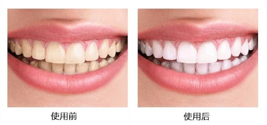 冷光牙齿美白多少钱,一次冷光美白牙多少钱