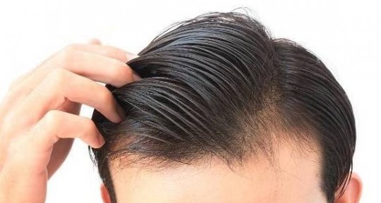 掉头发严重吃什么东西可以改善-掉头发严重吃什么东西可以改善买什么药