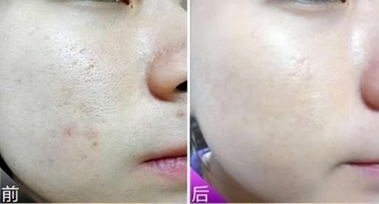 光子美白嫩肤,光子可以美白嫩肤吗