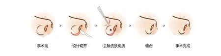 鼻翼缩小手术费,缩鼻翼手术大概要多少钱