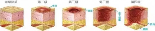 褥疮的治疗,褥疮该怎么治疗