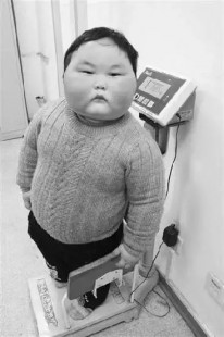 满月脸 水牛背,水牛背满月脸是什么病