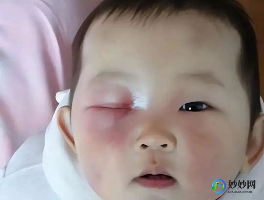 八个月婴儿散光能恢复正常吗,八个月宝宝眼睛散光怎么恢复正常