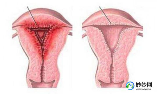 子宫不发育女性能否成功受孕揭秘与科学探索