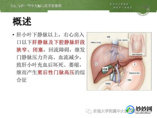 断掌21三体综合征,断掌21三体综合征是啥病
