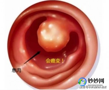 肠息肉的主要症状有哪些,肠息肉的主要症状有哪些