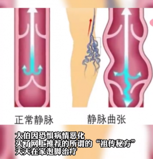 静脉曲张怎么治疗最好的方法,静脉曲张用什么方法治疗好