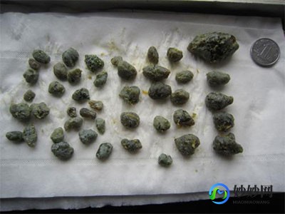 结石用什么药最好,结石病吃什么药
