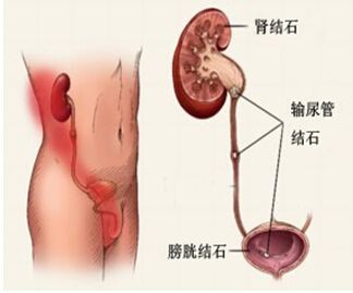 肾结石是怎么产生的,肾结石是怎样形成的