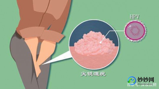 尖锐湿疣外用药,尖锐疣湿擦什么药