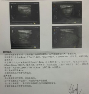 甲状腺结节吃什么药可以消除结节,甲状腺结节吃什么药能散结