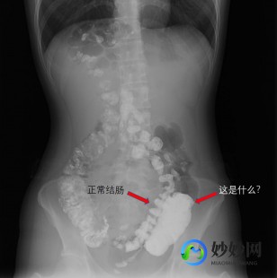 灌肠,手术前灌肠体验,疼痛程度及持续时间全解析
