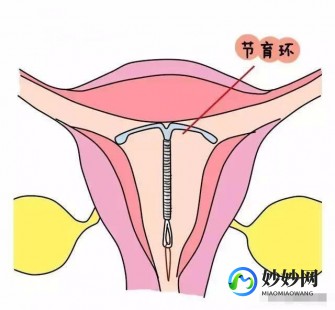 带环后月经,带节育环后月经不正常怎么办