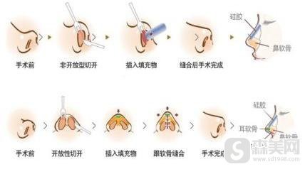 鼻翼缩小手术费用,缩鼻翼手术大概要多少钱