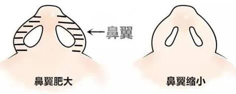 鼻翼缩小手术费用,缩鼻翼手术大概要多少钱