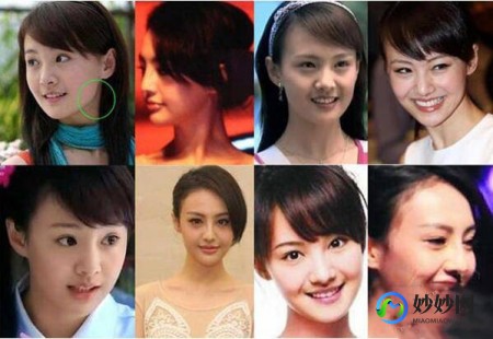 郑爽整形,郑爽公开承认整容整容对比网友惋惜