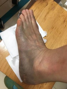 郑州脉管炎,郑州治疗脉管炎的方法有哪些
