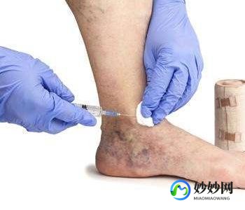 郑州脉管炎,郑州治疗脉管炎的方法有哪些