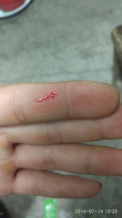 1-2mm深伤口要打破伤风么,1-2MM深伤口要打破伤风吗