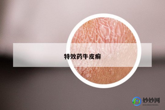 特莱斯顿软膏,特莱斯顿软膏治牛皮癣吗-