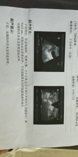 多囊严重吗,妇科多囊严重吗
