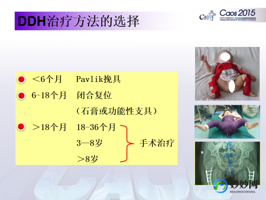 phh,phh手术什么意思