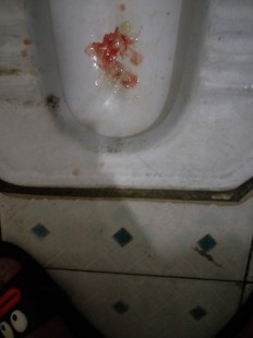 咳嗽咳出血,咳嗽带血丝怎么回事