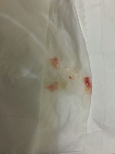 咳嗽咳出血,咳嗽带血丝怎么回事