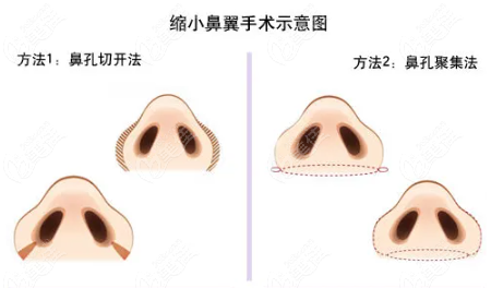 鼻翼缩小需要多少钱,缩鼻翼手术大概要多少钱