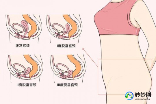 阴挺的图片及症状,阴挺_阴挺的症状_阴挺治疗方法_阴挺用药_疾病百科