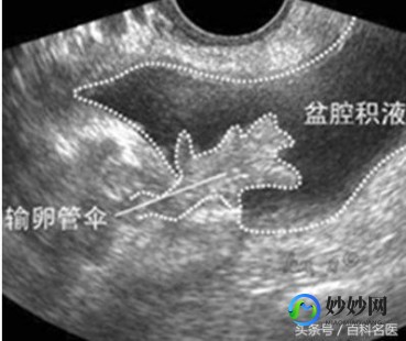 宫内早孕盆腔积液,怀孕早期有盆腔积液正常吗