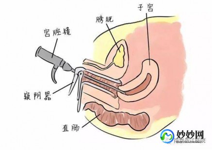 做宫腔镜多少钱,2024杭州宫腔镜检查手术要多少钱？哪里做宫腔镜检查手术好