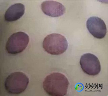 来姨妈能拔罐吗,女性经期可以拔火罐吗