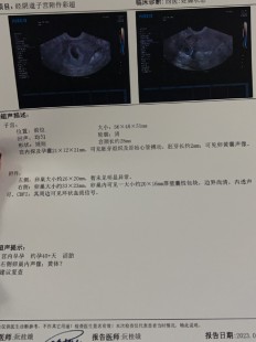 5周有胎心胎芽吗,怀孕5周有胎心胎芽吗