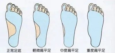 扁平足鞋垫有用吗,扁平足鞋垫有用吗