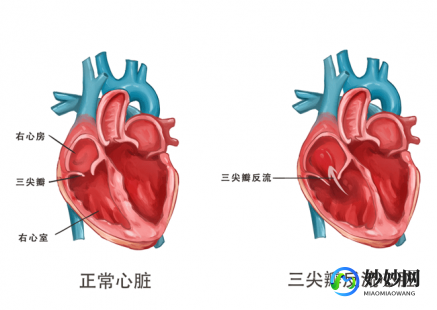 三尖瓣关闭不全,三尖瓣关闭不全是什么意思