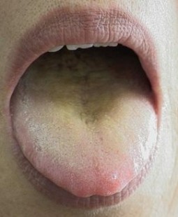 舌苔发黄厚腻是什么原因怎么调理,舌苔发黄厚腻是什么原因怎么调理