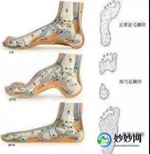 平足,什么是扁平足