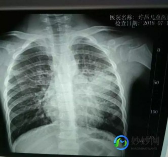 ct片子怎么看,怎么看CT检查的结果
