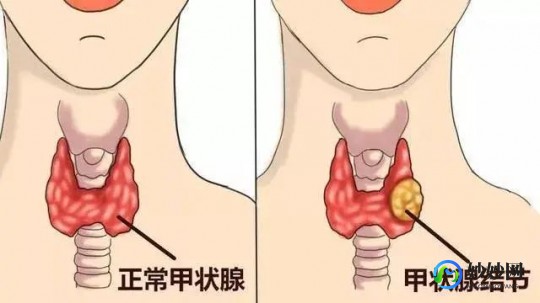 甲状腺结节能喝茶吗,甲状腺结节可以喝茶吗