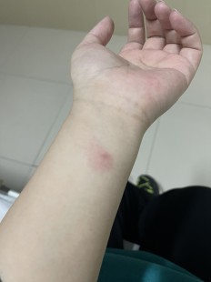 ppd是什么意思,什么是结核菌素试验PPD