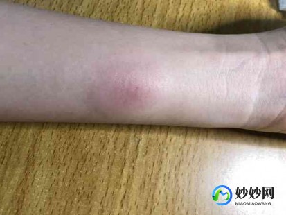 ppd是什么意思,什么是结核菌素试验PPD