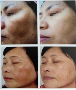 光子嫩肤黄褐斑,光子嫩肤可以去黄褐斑吗