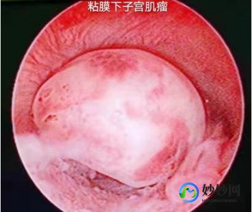 做一次宫腔镜价格,2024杭州宫腔镜检查手术要多少钱？哪里做宫腔镜检查手术好