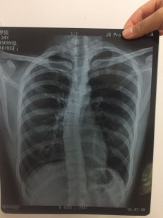 脊柱侧弯能当兵吗,脊柱侧弯体检能过吗