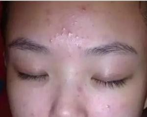 封闭性粉刺,封闭性粉刺
