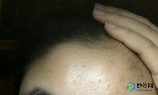 封闭性粉刺,封闭性粉刺