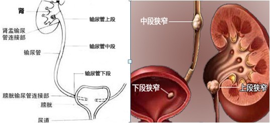 输尿管结石严重吗,尿管结石严重吗